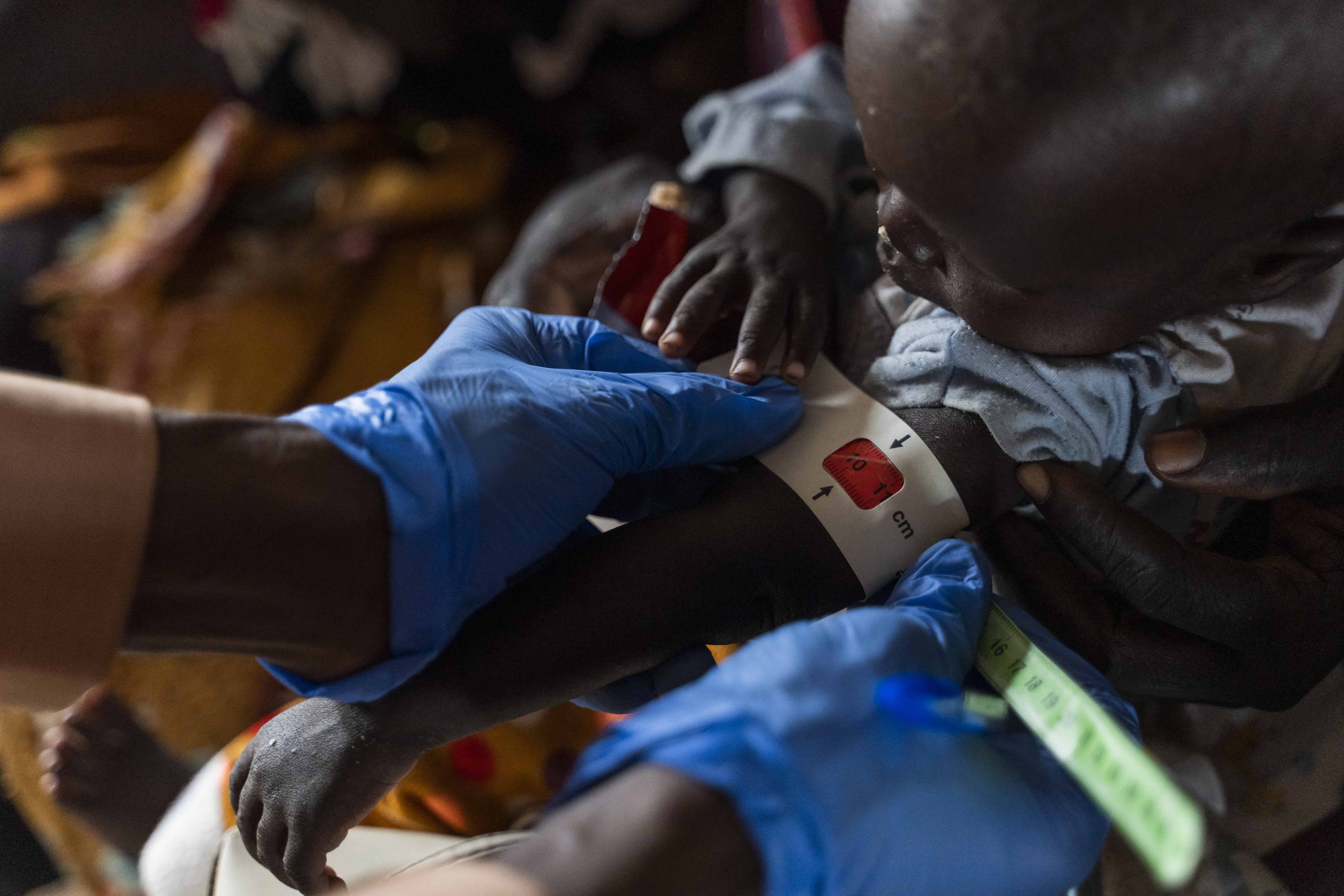 A health worker conducts an arm band test to check for malnutrition among children at a camp in Sudan